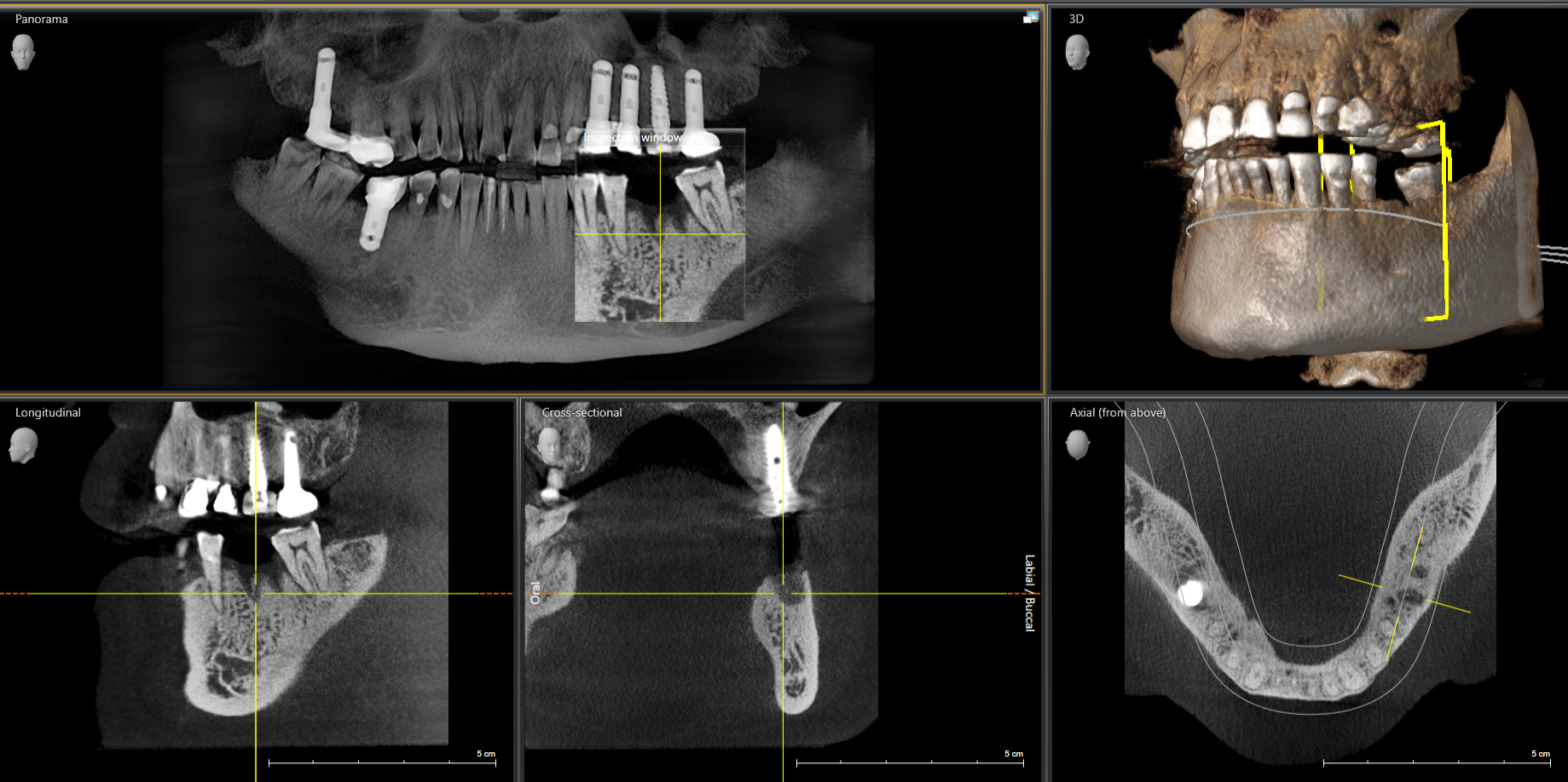 CBCT scan